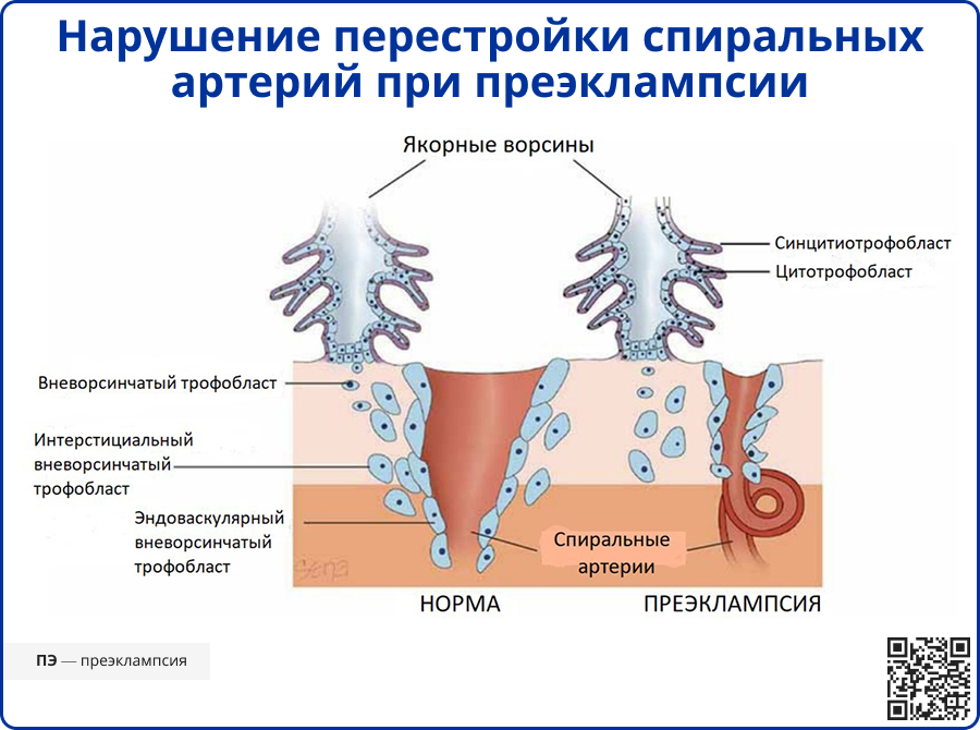 Нарушение перестройки спиральных артерий при преэклампсии